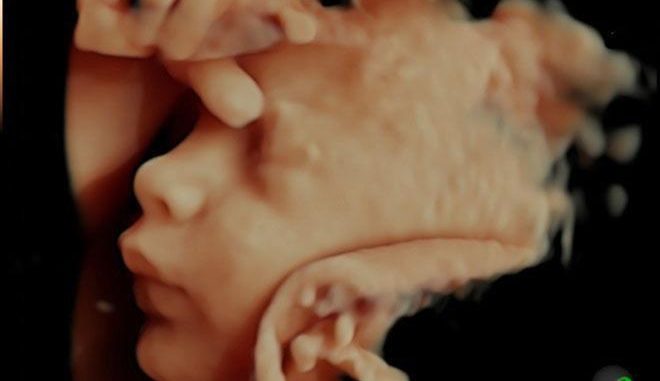 Ultrasound